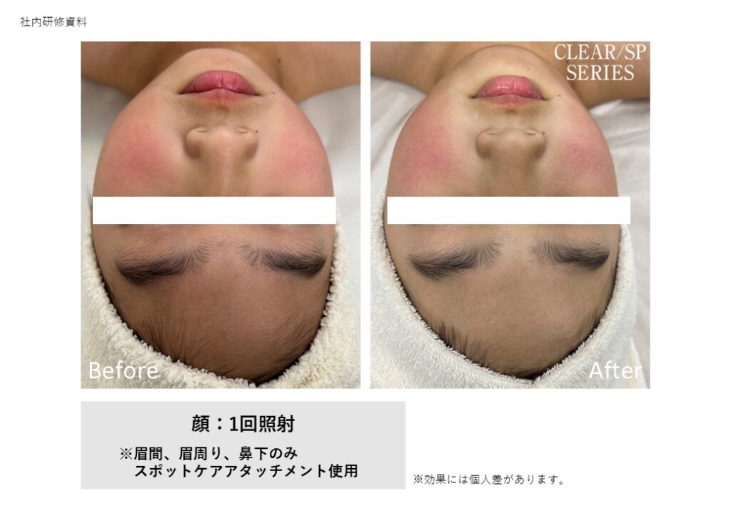 奈良県大和高田市の脱毛サロンvivio.のビフォーアフター