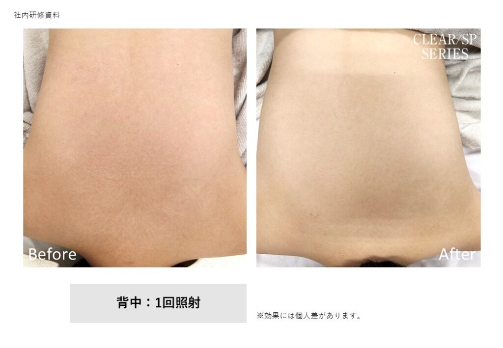 奈良県橿原市の脱毛ビフォーアフター｜vivio.