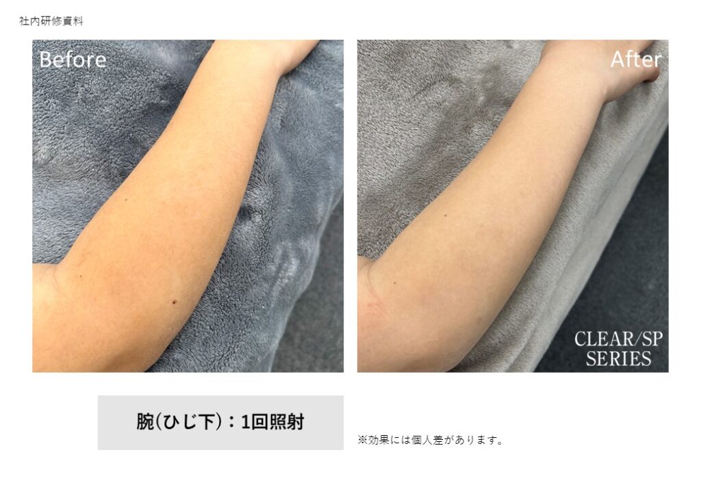 奈良県香芝市の脱毛ビフォーアフター｜vivio.