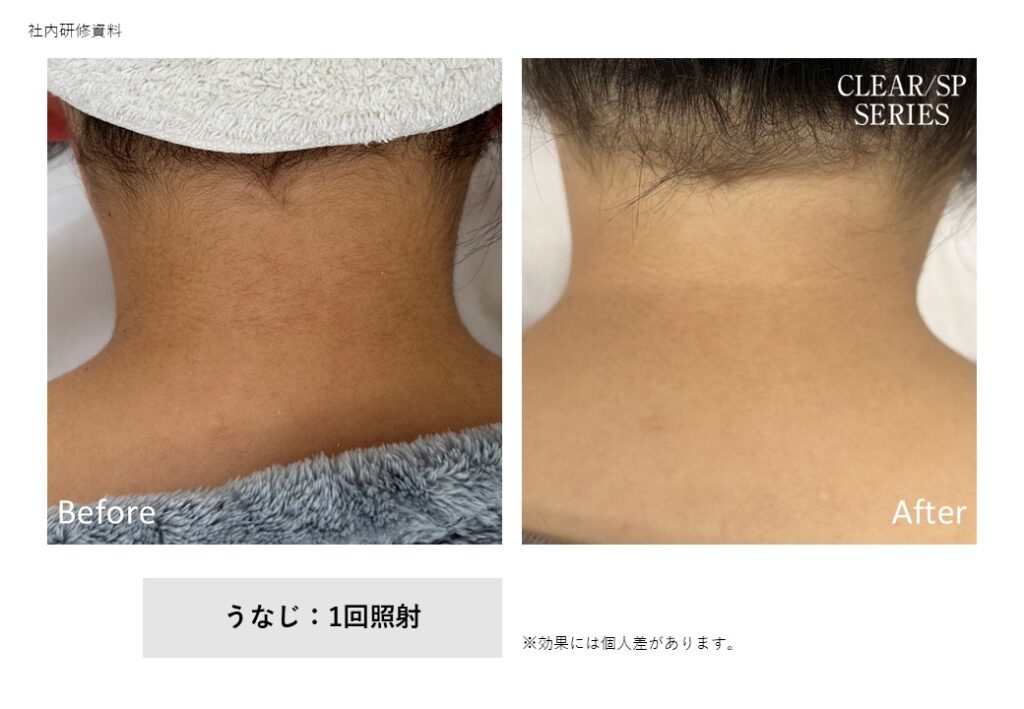 奈良県葛城市の脱毛ビフォーアフター｜vivio.