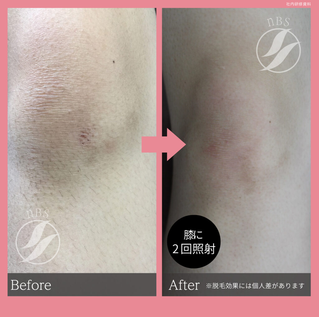 奈良大和高田市のひざ脱毛ビフォーアフター｜vivio.