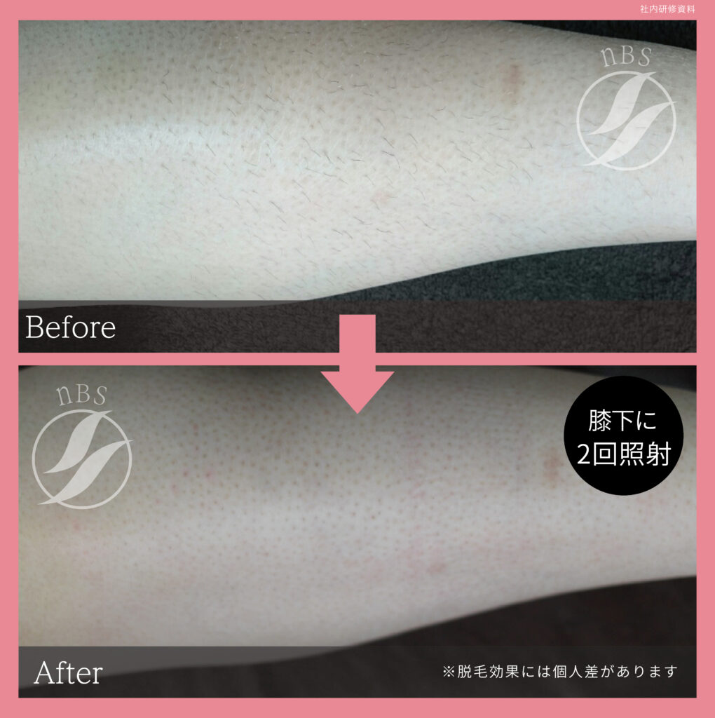 奈良大和高田市のひざ下脱毛ビフォーアフター｜vivio.