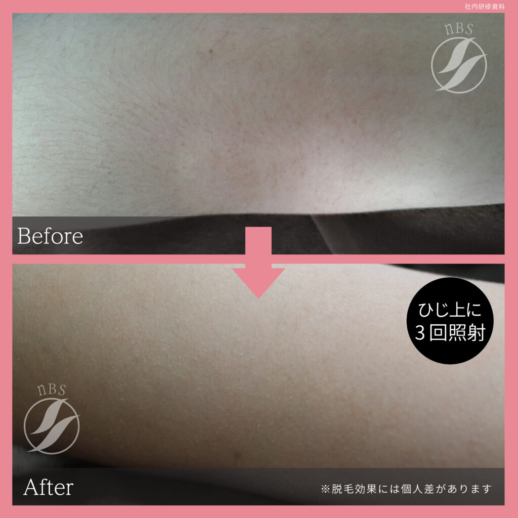 奈良大和高田市のひじ上脱毛ビフォーアフター｜vivio.