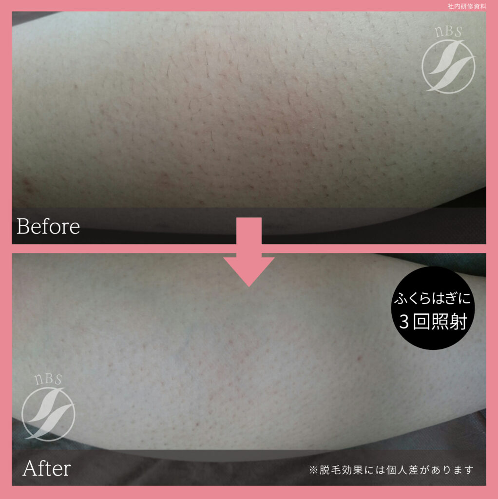 奈良大和高田市のふくらはぎ脱毛ビフォーアフター｜vivio.