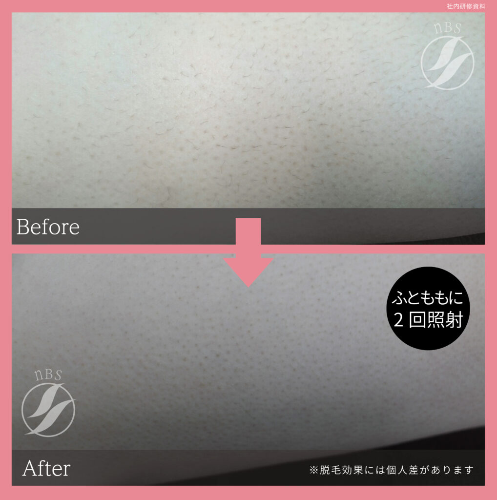 奈良大和高田市の太もも脱毛ビフォーアフター｜vivio.
