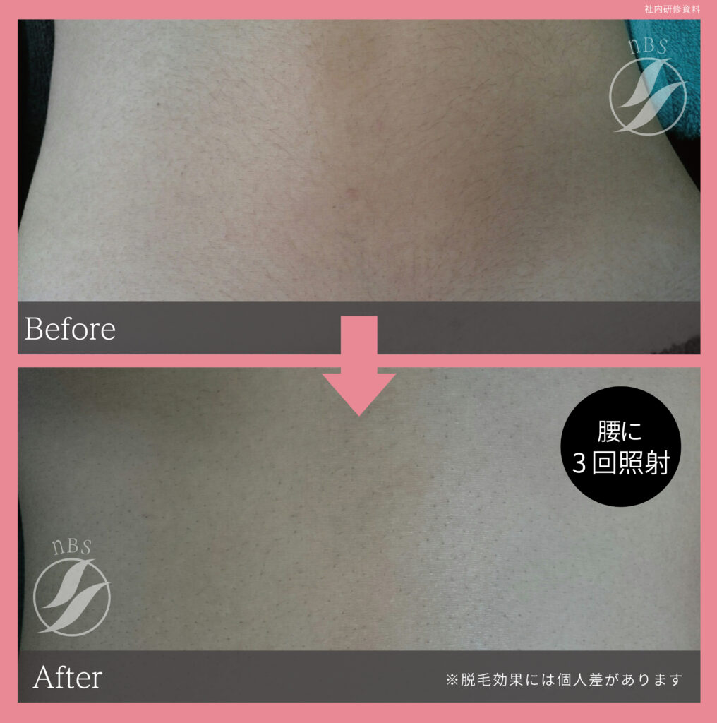 奈良大和高田市の腰脱毛ビフォーアフター｜vivio.