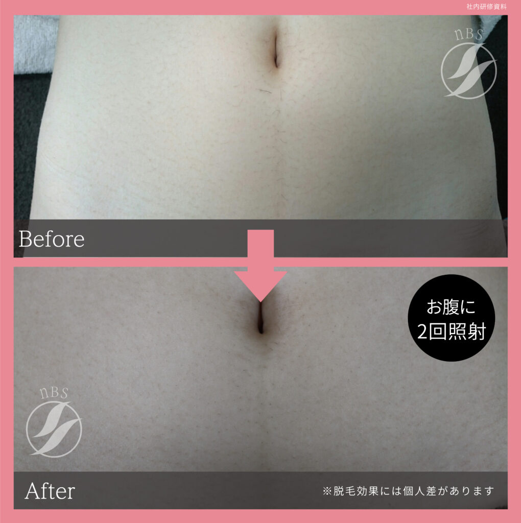 奈良大和高田市のお腹脱毛ビフォーアフター｜vivio.