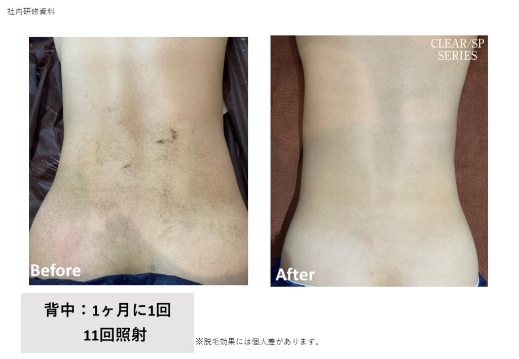 奈良県の全身脱毛ビフォーアフター｜vivio.大和高田