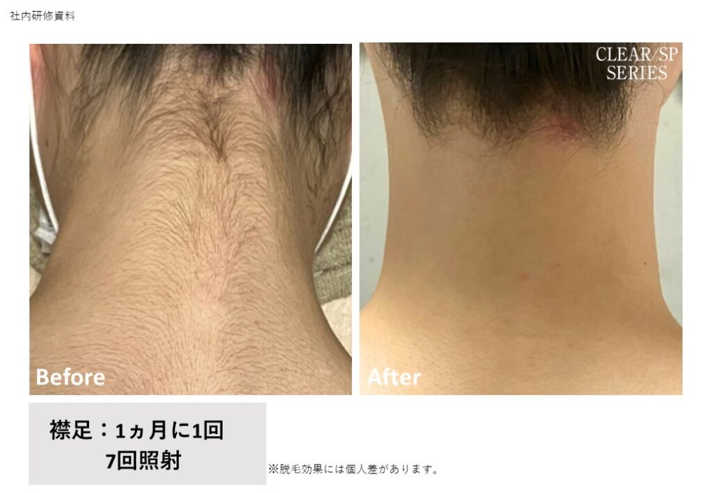 奈良県香芝市の全身脱毛ビフォーアフター｜vivio.