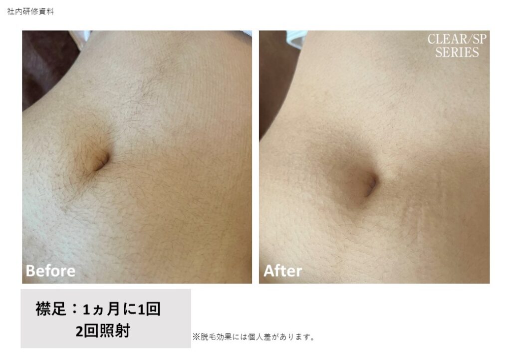 奈良県五條市の全身脱毛ビフォーアフター｜vivio.