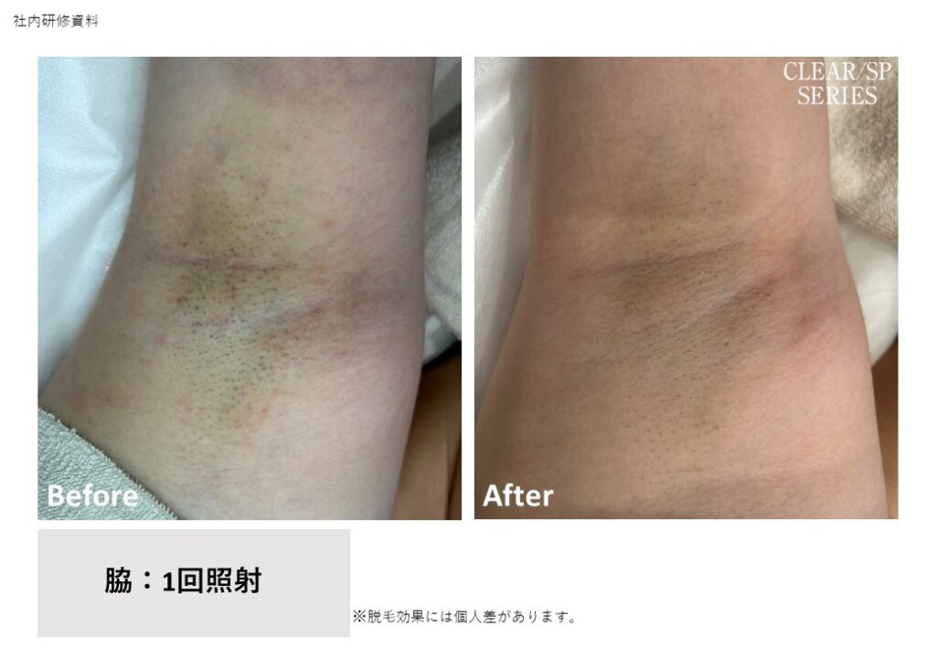奈良県葛城市の全身脱毛ビフォーアフター｜vivio.