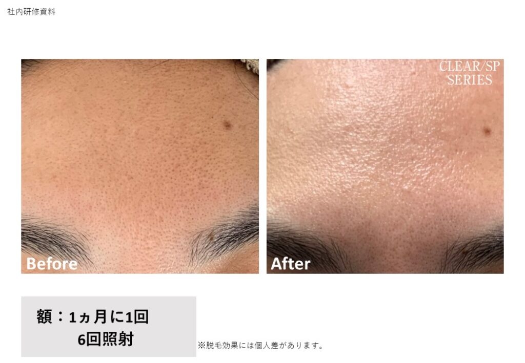 奈良県御所市の全身脱毛ビフォーアフター｜vivio.