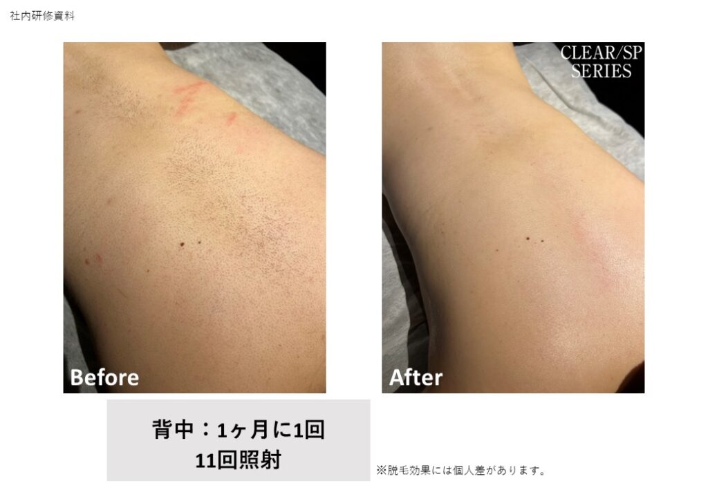 奈良大和高田市のVIO脱毛ビフォーアフター｜vivio.