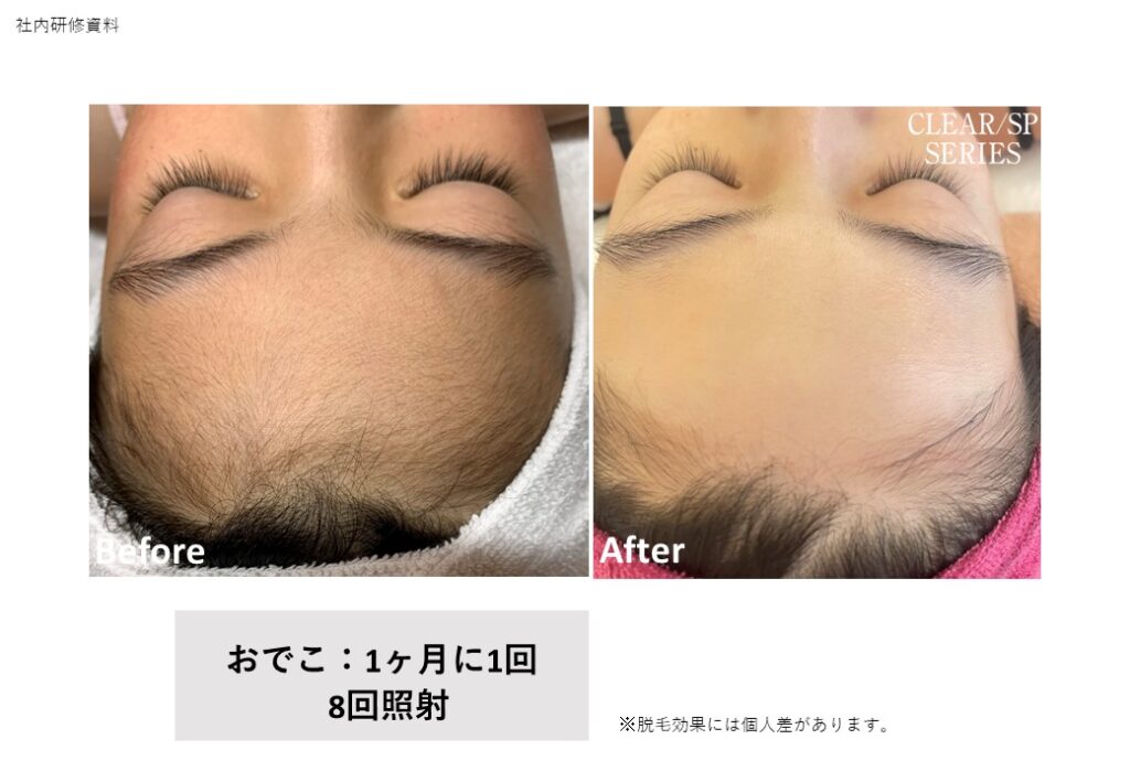 奈良大和高田市のVIO脱毛施術前後の比較｜vivio.