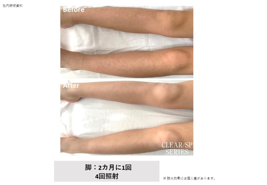 奈良県の全身脱毛効果ビフォーアフター｜女性専用vivio.