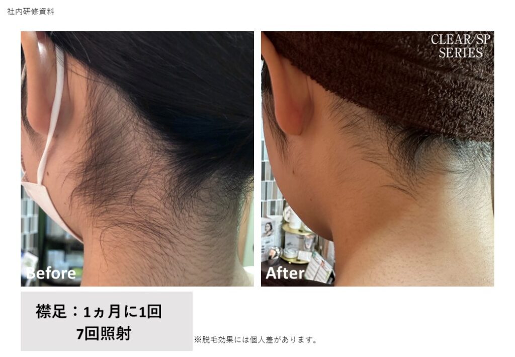 奈良県大和高田市の全身脱毛施術前後の比較写真