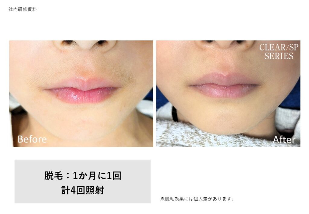 奈良橿原市の顔脱毛ビフォーアフター｜vivio.