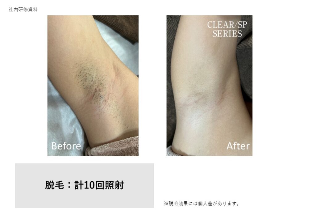 奈良香芝市の顔脱毛ビフォーアフター｜vivio.