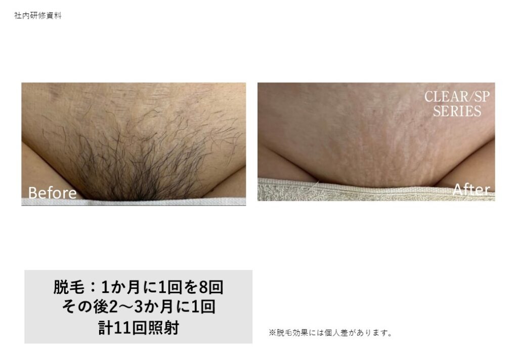 奈良大和高田市の顔脱毛ビフォーアフター｜vivio.