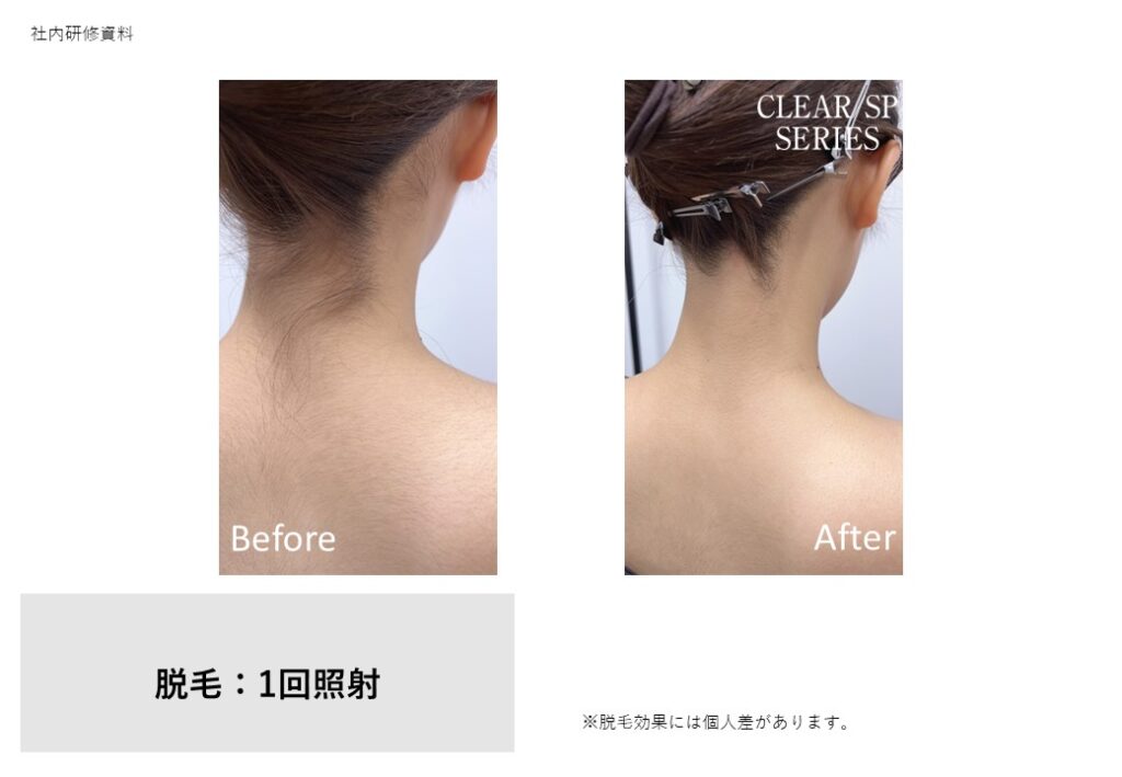奈良大和高田市のうなじ脱毛ビフォーアフター｜vivio.