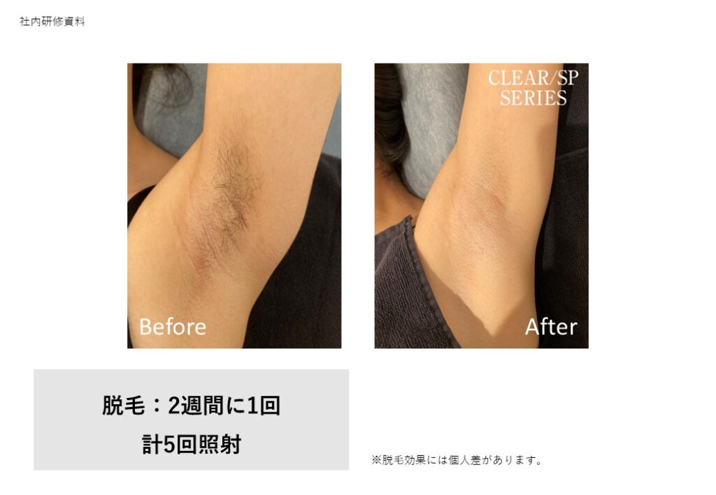 奈良大和高田市のうなじ脱毛効果ビフォーアフター｜vivio.