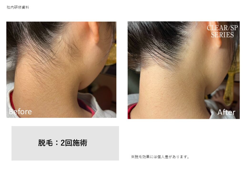 奈良橿原市のうなじ脱毛ビフォーアフター｜vivio.