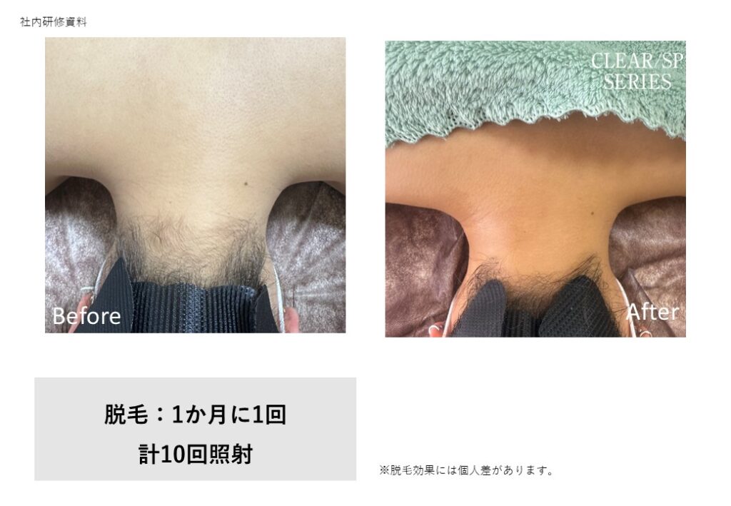 奈良大和高田市のワキ脱毛ビフォーアフター｜vivio.