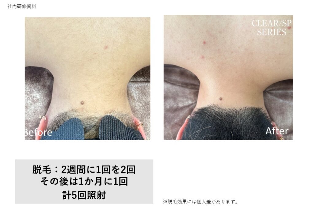 奈良大和高田市のワキ脱毛効果ビフォーアフター｜vivio.