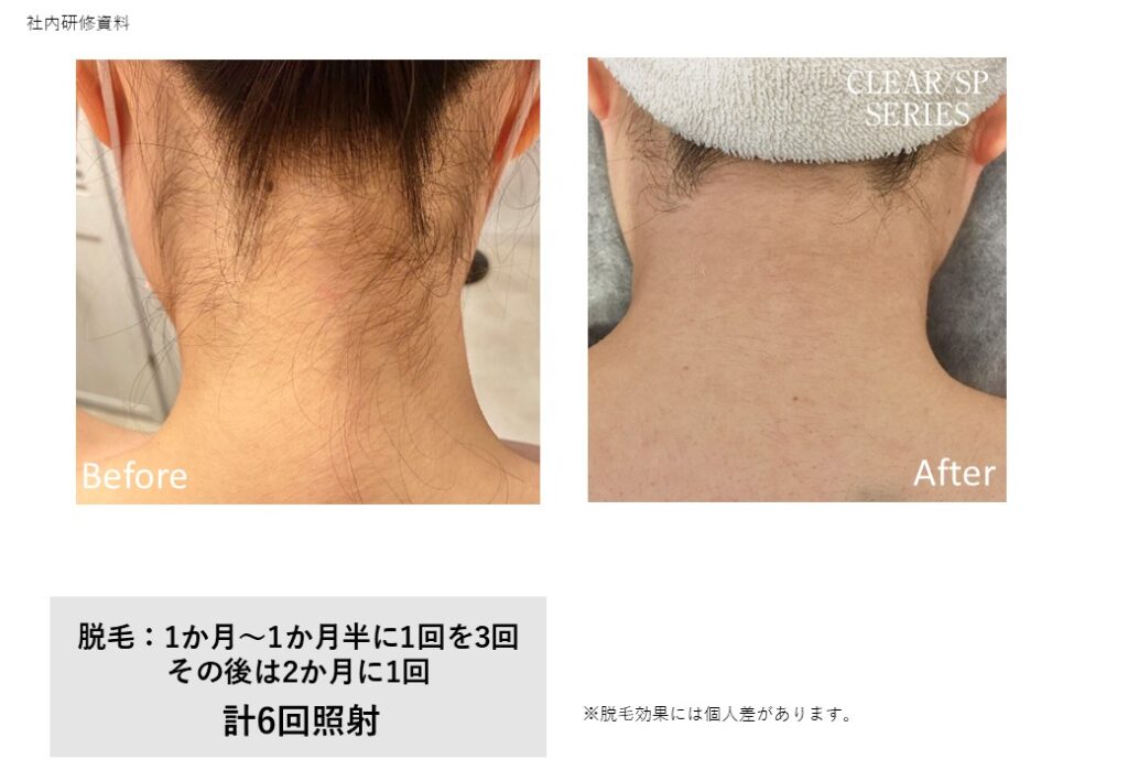 奈良橿原市のワキ脱毛ビフォーアフター｜vivio.