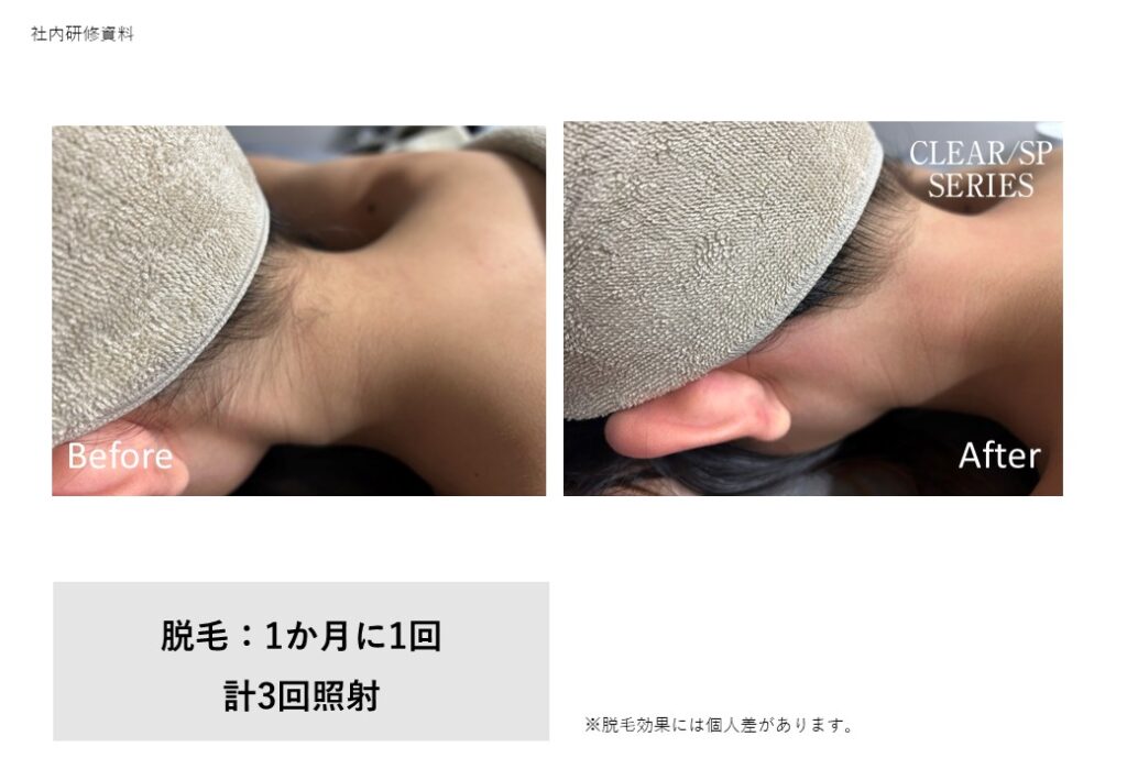 奈良大和高田市の顔脱毛効果ビフォーアフター｜女性専用vivio.