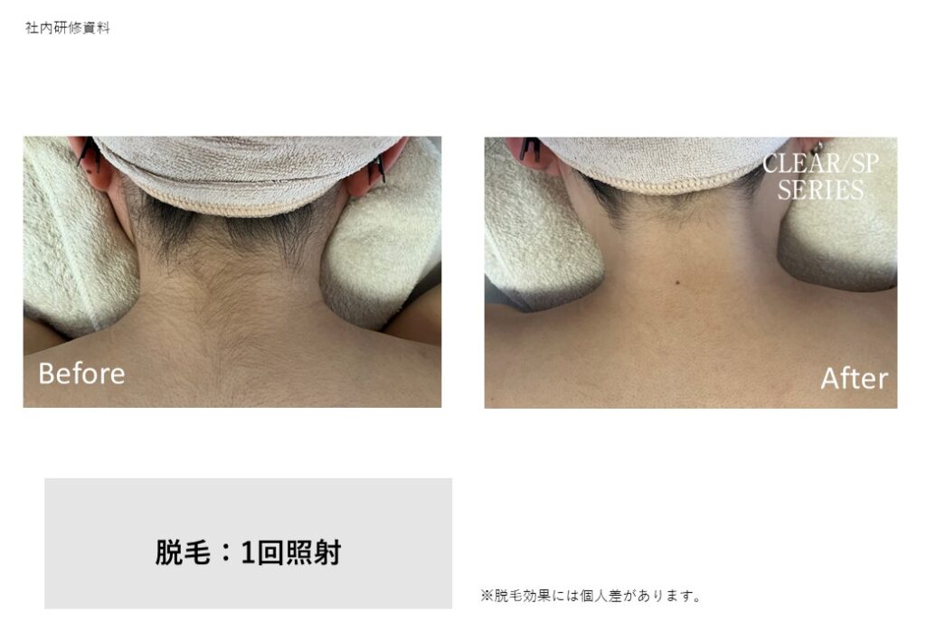 奈良大和高田市の脱毛ビフォーアフター写真｜vivio.女性専用サロン